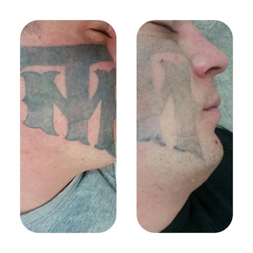 Tattoo Removal before & After